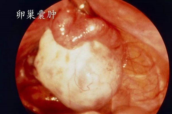 卵巢肿瘤是女性生殖器普遍恶性肿瘤