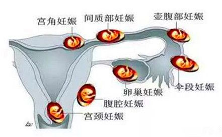 生化妊娠怀孕布局图