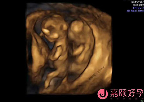 乌克兰促孕双胞胎宝宝小宝宝B超图