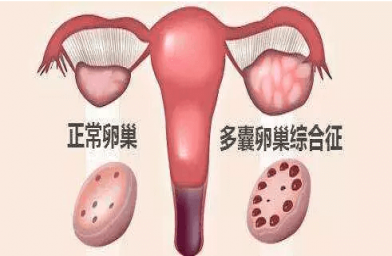 患有多囊卵巢综合症，应该怎样科学做试管？--全球试管婴儿预约 | 费用 