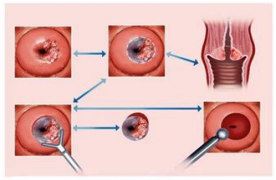 胚胎移植后阴道出血是为什么--全球试管婴儿预约 | 费用 