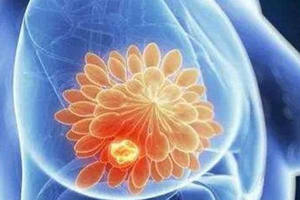 乳腺癌5种治疗方法